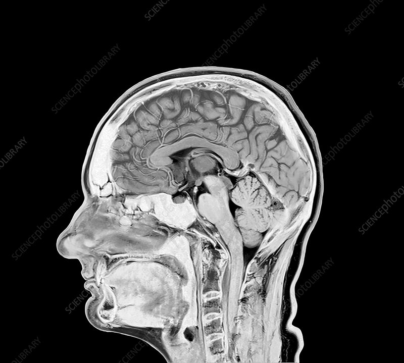 MRI